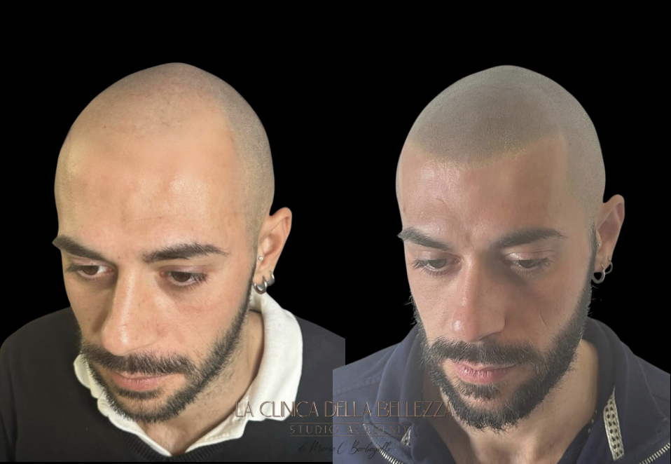 Barbagallo Tricopigmentazione