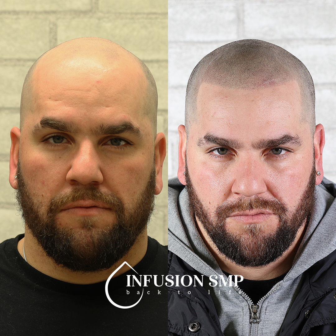 Infusion SMP Scalp Micropigmentation